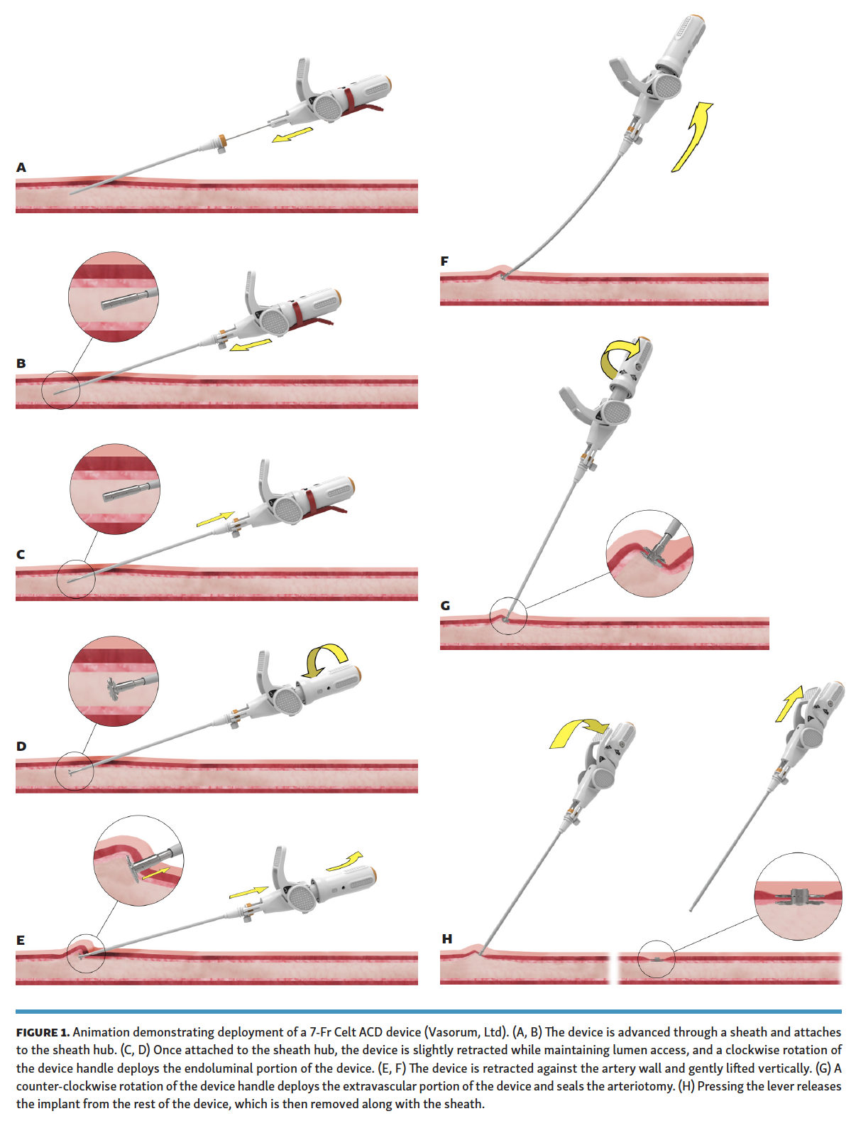 A SingleCenter, SingleOperator Experience With the Celt ACD Vascular